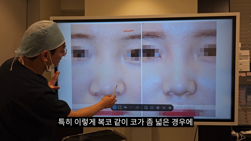 예쁜 코를 위한 비주와 콧날개에 대해 알려드립니다! 2편 (넓은코, 처진콧날개) 사진 4