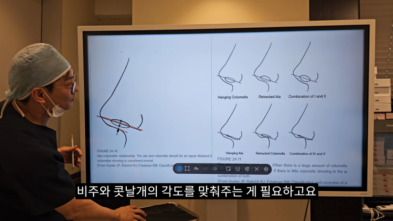 예쁜 코를 위한 비주와 콧날개에 대해 알려드립니다! 2편 (넓은코, 처진콧날개) 사진 13