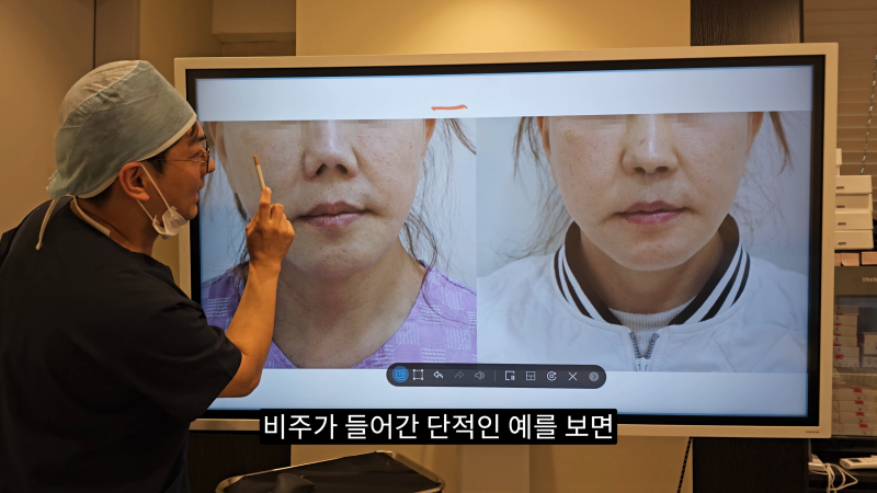 예쁜 코를 위한 비주와 콧날개에 대해 알려드립니다! 2편 (넓은코, 처진콧날개)