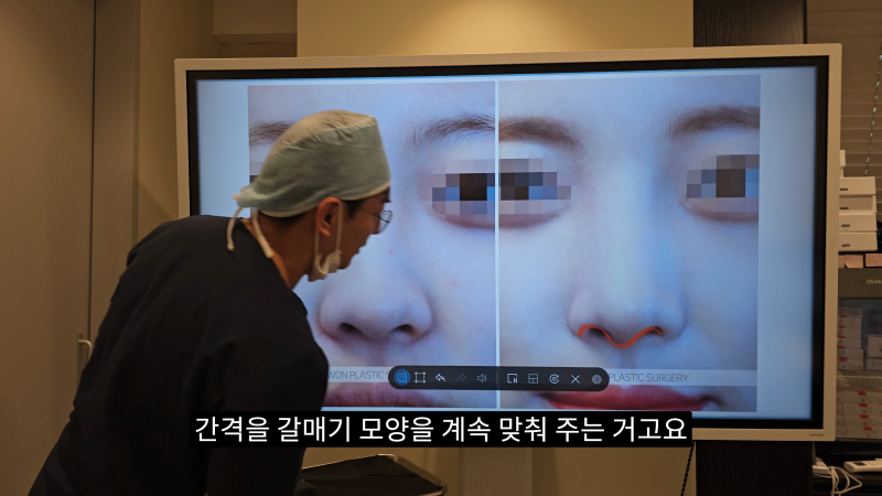 예쁜 코를 위한 비주와 콧날개에 대해 알려드립니다! 2편 (넓은코, 처진콧날개) 사진 15