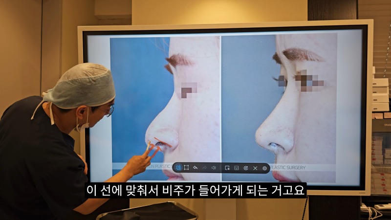 예쁜 코를 위한 비주와 콧날개에 대해 알려드립니다! 2편 (넓은코, 처진콧날개) 사진 10