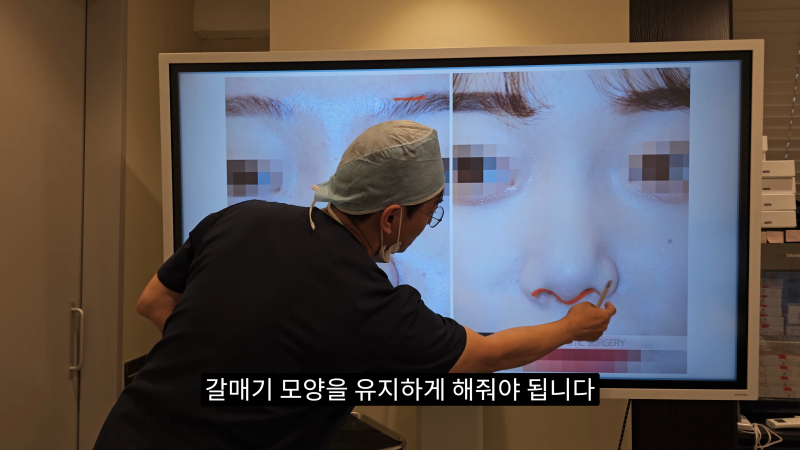 예쁜 코를 위한 비주와 콧날개에 대해 알려드립니다! 2편 (넓은코, 처진콧날개) 사진 7
