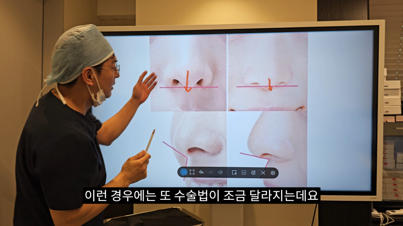 예쁜 코를 위한 비주와 콧날개에 대해 알려드립니다! 2편 (넓은코, 처진콧날개) 사진 8