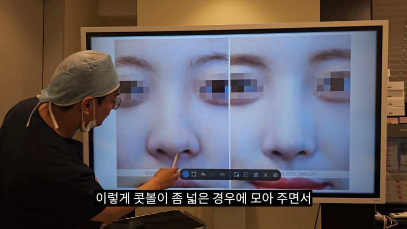 예쁜 코를 위한 비주와 콧날개에 대해 알려드립니다! 2편 (넓은코, 처진콧날개) 사진 14