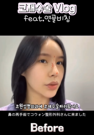 연골 비침 때문에 코원에서 코재수술 했어요!