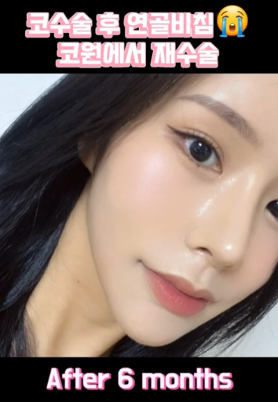 연골 비침 때문에 코원에서 코재수술 했어요! 사진 12