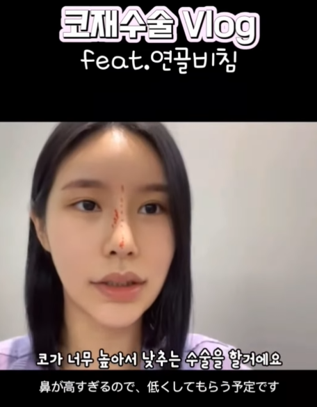 연골 비침 때문에 코원에서 코재수술 했어요! 사진 3
