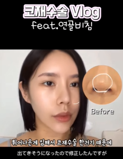 연골 비침 때문에 코원에서 코재수술 했어요! 사진 7