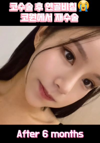 연골 비침 때문에 코원에서 코재수술 했어요! 사진 13