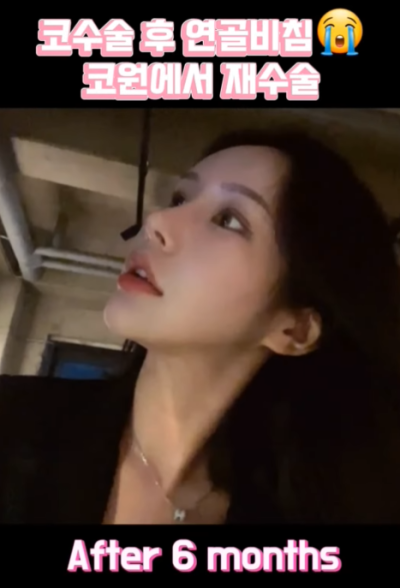 연골 비침 때문에 코원에서 코재수술 했어요! 사진 15