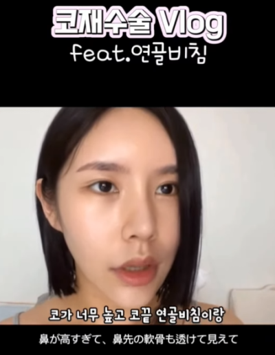 연골 비침 때문에 코원에서 코재수술 했어요! 사진 6