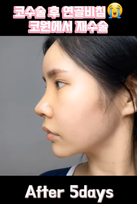 연골 비침 때문에 코원에서 코재수술 했어요! 사진 10