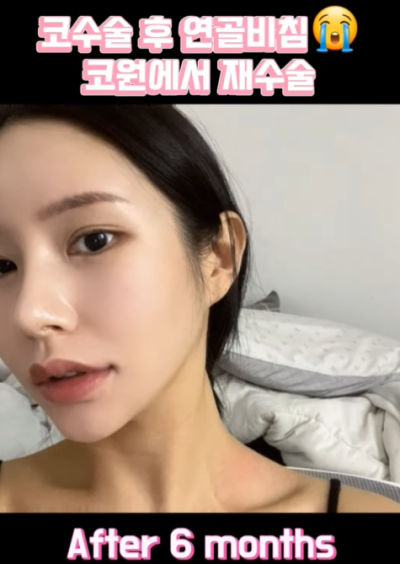 연골 비침 때문에 코원에서 코재수술 했어요! 사진 14