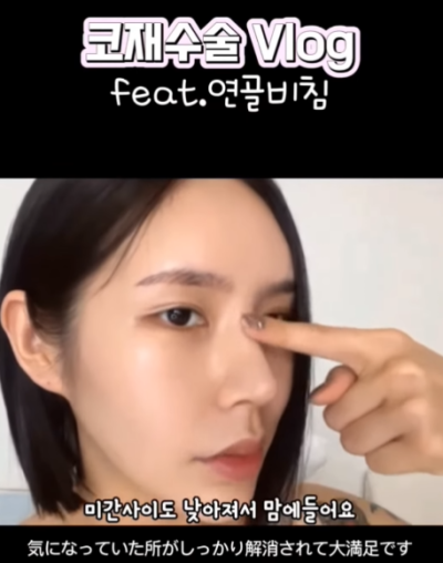 연골 비침 때문에 코원에서 코재수술 했어요! 사진 8