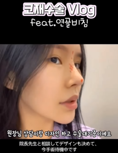 연골 비침 때문에 코원에서 코재수술 했어요!
