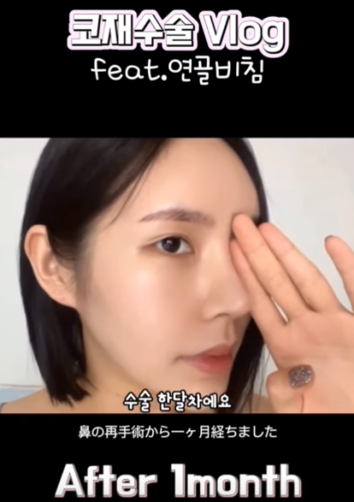 연골 비침 때문에 코원에서 코재수술 했어요! 사진 4