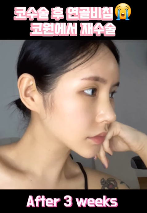 연골 비침 때문에 코원에서 코재수술 했어요! 사진 11