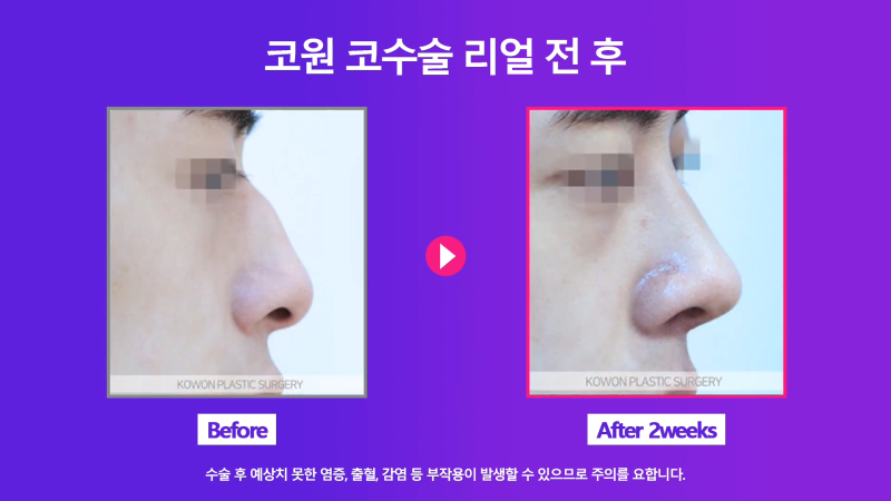 남성 매부리코 교정과 코끝성형을 통해 깔끔하고 멋진 콧대 만들기! 사진 8