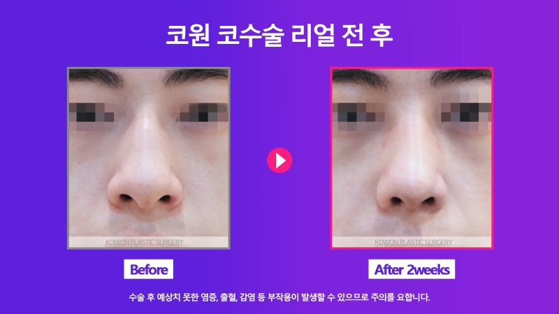 남성 매부리코 교정과 코끝성형을 통해 깔끔하고 멋진 콧대 만들기! 사진 5