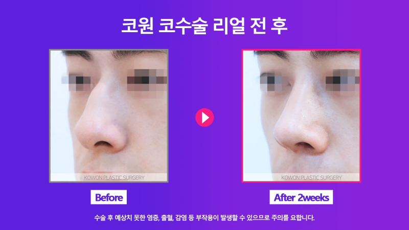 남성 매부리코 교정과 코끝성형을 통해 깔끔하고 멋진 콧대 만들기! 사진 7