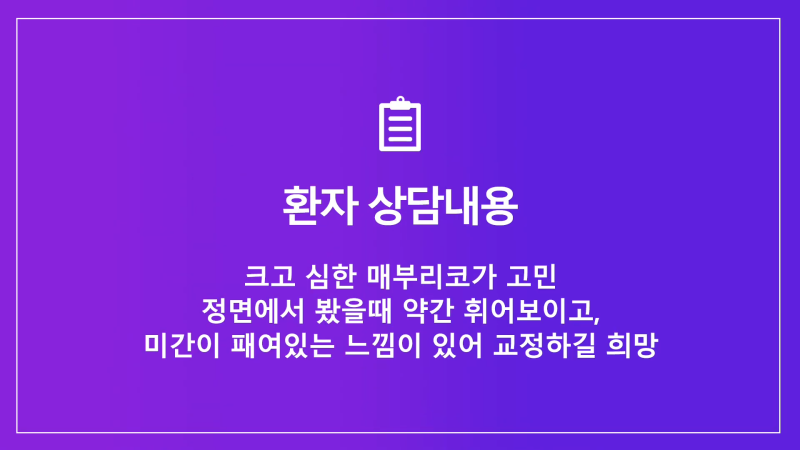 남성 매부리코 교정과 코끝성형을 통해 깔끔하고 멋진 콧대 만들기!