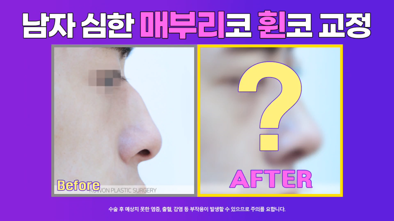 남성 매부리코 교정과 코끝성형을 통해 깔끔하고 멋진 콧대 만들기!