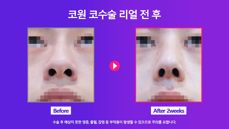 남성 매부리코 교정과 코끝성형을 통해 깔끔하고 멋진 콧대 만들기! 사진 6
