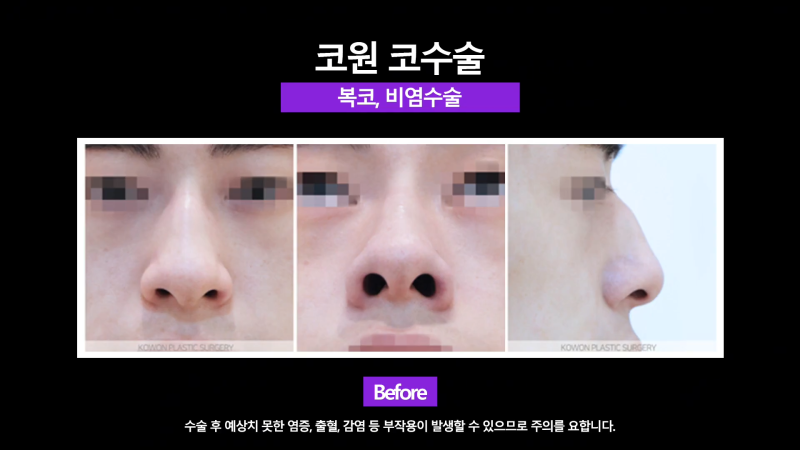 남성 매부리코 교정과 코끝성형을 통해 깔끔하고 멋진 콧대 만들기! 사진 4