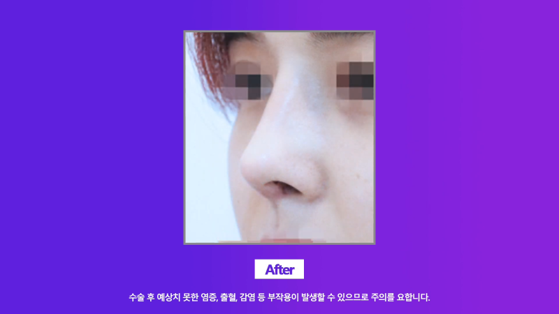 콧구멍짝짝이 개선, 화려한 직반버선코로 코재수술한 분의 후기! 사진 6