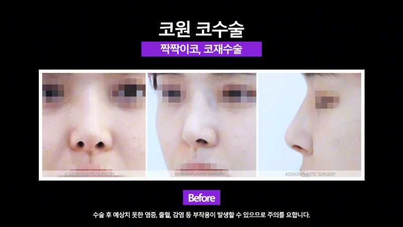 콧구멍짝짝이 개선, 화려한 직반버선코로 코재수술한 분의 후기! 사진 3