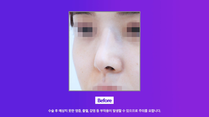 콧구멍짝짝이 개선, 화려한 직반버선코로 코재수술한 분의 후기! 사진 4