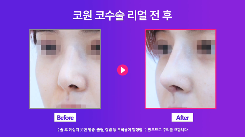 콧구멍짝짝이 개선, 화려한 직반버선코로 코재수술한 분의 후기! 사진 7