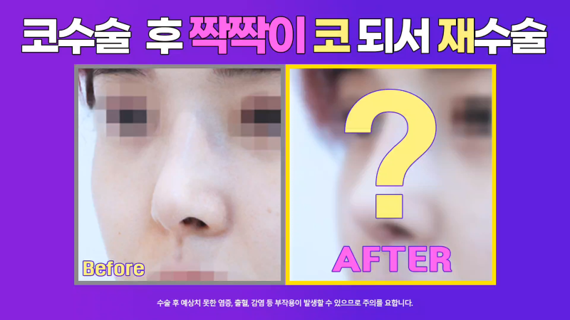 콧구멍짝짝이 개선, 화려한 직반버선코로 코재수술한 분의 후기!