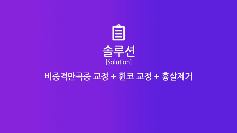 콧구멍짝짝이 개선, 화려한 직반버선코로 코재수술한 분의 후기! 사진 5
