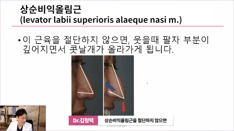 화살코교정의 핵심은 비중격내림근과 상순비익올림근 제거입니다. 이 근육들을 절단하지 않으면 어떻게 될까요? 사진 6