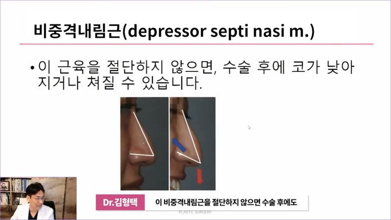 화살코교정의 핵심은 비중격내림근과 상순비익올림근 제거입니다. 이 근육들을 절단하지 않으면 어떻게 될까요? 사진 5