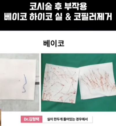 베이코/하이코 시술 부작용으로 실 제거와 필러 제거에 대하여-1편 사진 10