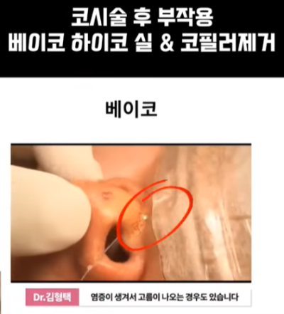 베이코/하이코 시술 부작용으로 실 제거와 필러 제거에 대하여-1편 사진 8