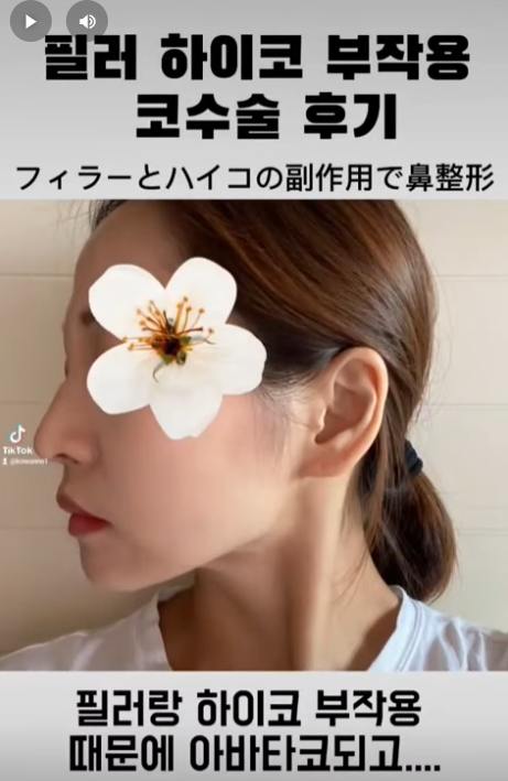 베이코/하이코 시술 부작용으로 실 제거와 필러 제거에 대하여-1편 사진 11