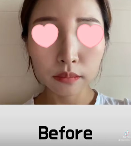 베이코/하이코 시술 부작용으로 실 제거와 필러 제거에 대하여-1편 사진 12