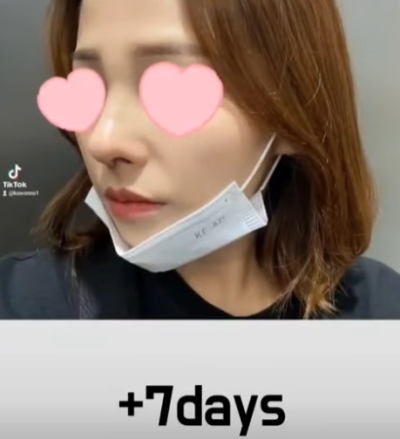베이코/하이코 시술 부작용으로 실 제거와 필러 제거에 대하여-1편 사진 14