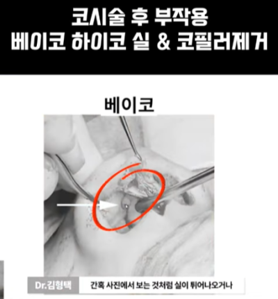 베이코/하이코 시술 부작용으로 실 제거와 필러 제거에 대하여-1편 사진 7