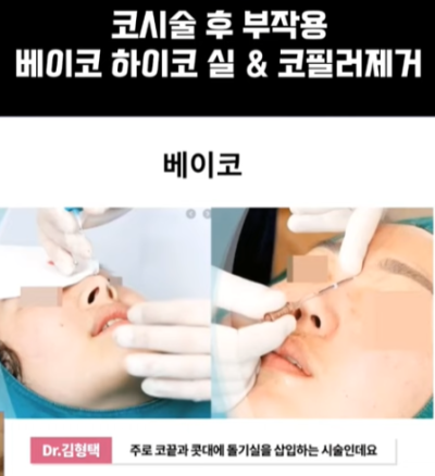 베이코/하이코 시술 부작용으로 실 제거와 필러 제거에 대하여-1편 사진 6