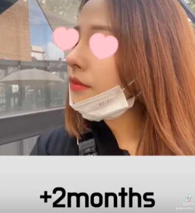 베이코/하이코 시술 부작용으로 실 제거와 필러 제거에 대하여-1편 사진 16