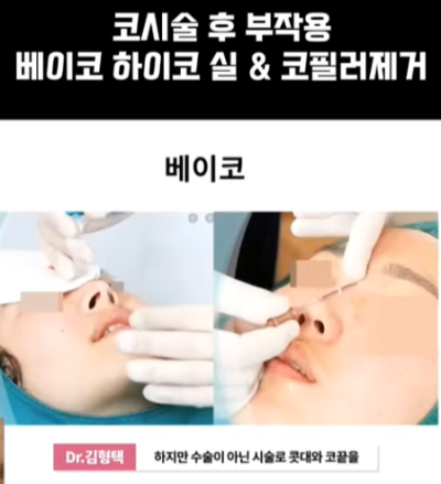 베이코/하이코 시술 부작용으로 실 제거와 필러 제거에 대하여-1편 사진 5