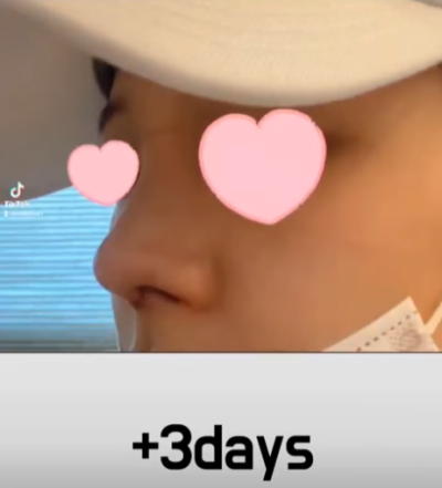 베이코/하이코 시술 부작용으로 실 제거와 필러 제거에 대하여-1편 사진 13