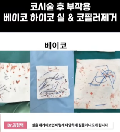 베이코/하이코 시술 부작용으로 실 제거와 필러 제거에 대하여-1편 사진 9