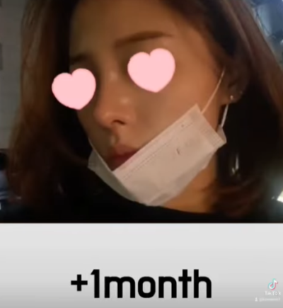 베이코/하이코 시술 부작용으로 실 제거와 필러 제거에 대하여-1편 사진 15