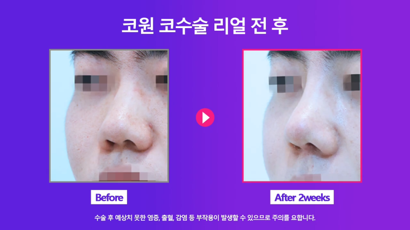 코끝연장과 보형물로 남자복코 개선한 후기! 사진 7
