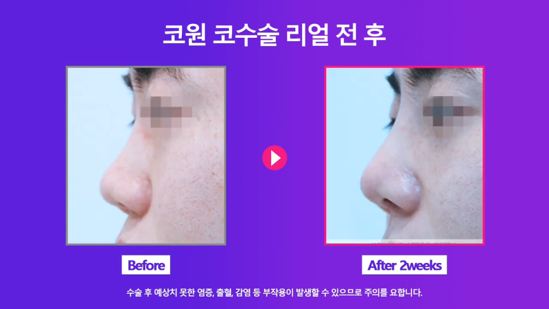 코끝연장과 보형물로 남자복코 개선한 후기! 사진 8